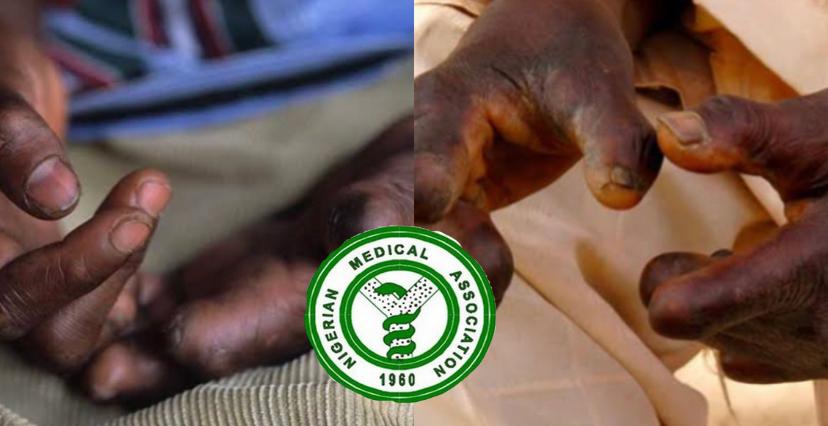 NMA seeks collaboration to eliminate leprosy