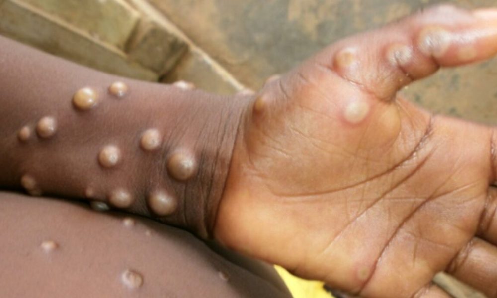 Cross River Govt confirms 1 case of Mpox