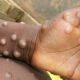 Cross River Govt confirms 1 case of Mpox